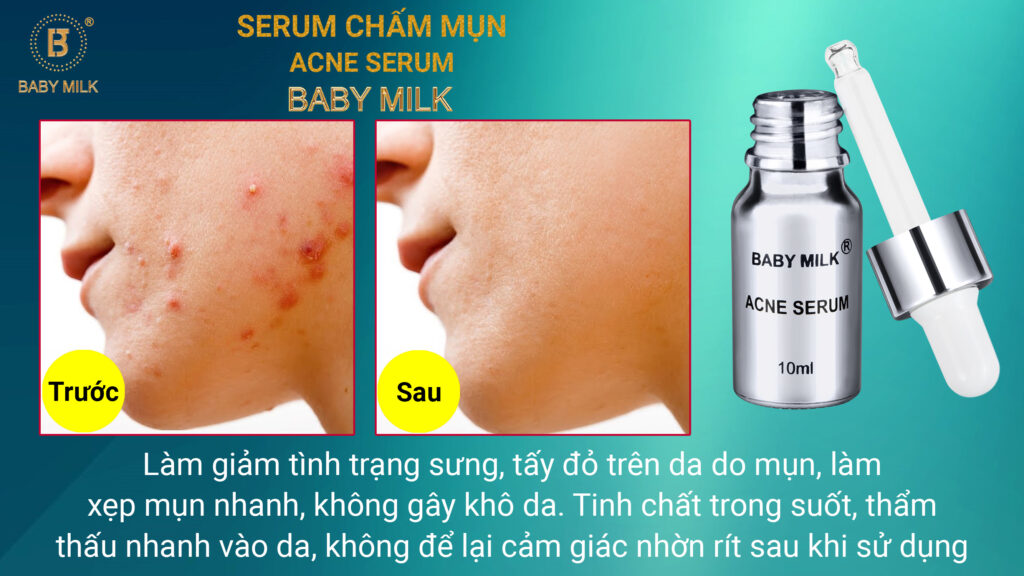 serum trị mụn Baby Milk